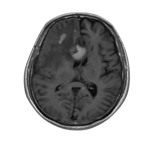 glioma