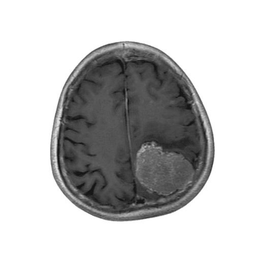 meningioma