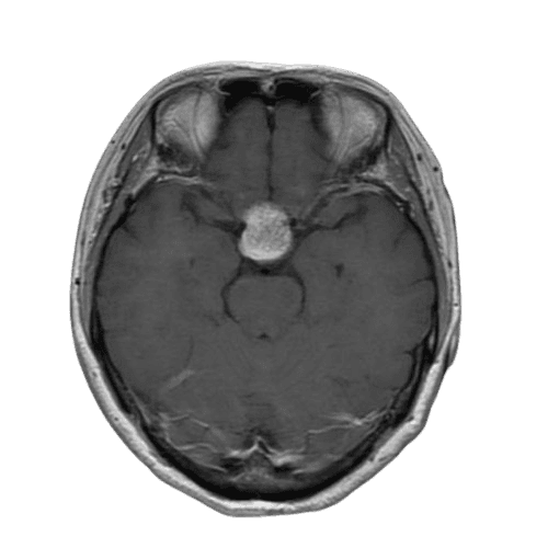pituitary